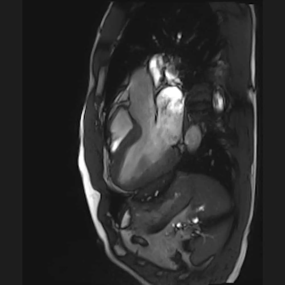 Herz-MRI bei ARISTRA Seitenansicht