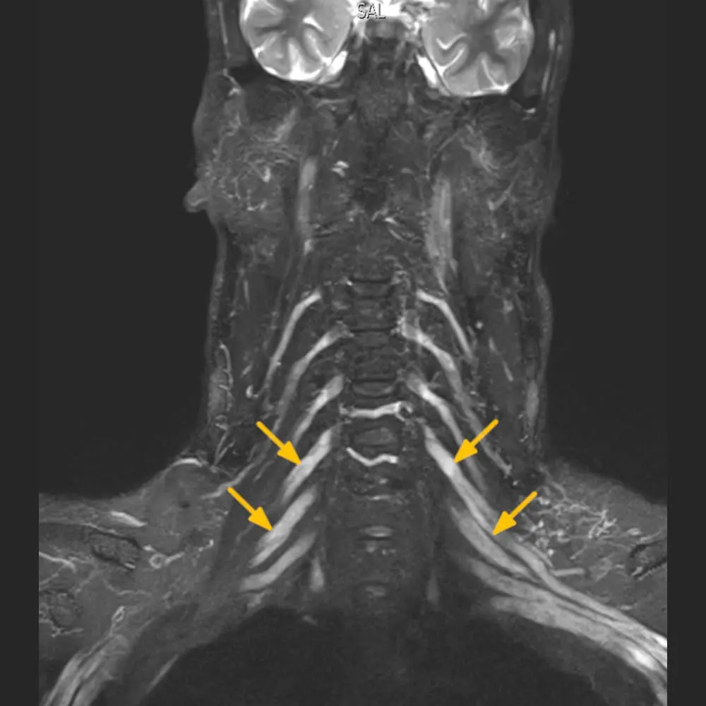 MRI-Aufnahme des peripheren Armgeflechts