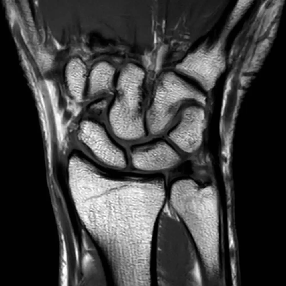 MRI-Aufnahme des Handgelenks