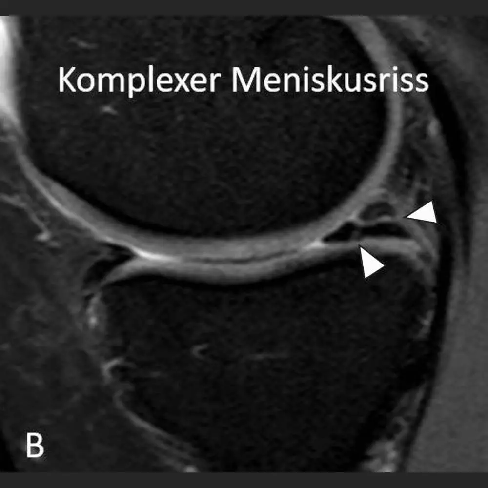MRI Knie seitliche Ansicht des Kniegelenkes. Komplexer Riss im Hinterhorn des Innenmeniskus (Pfeile). Komplex, da der Riss in verschiedene Richtungen (horizontal und schräg vertikal) verläuft