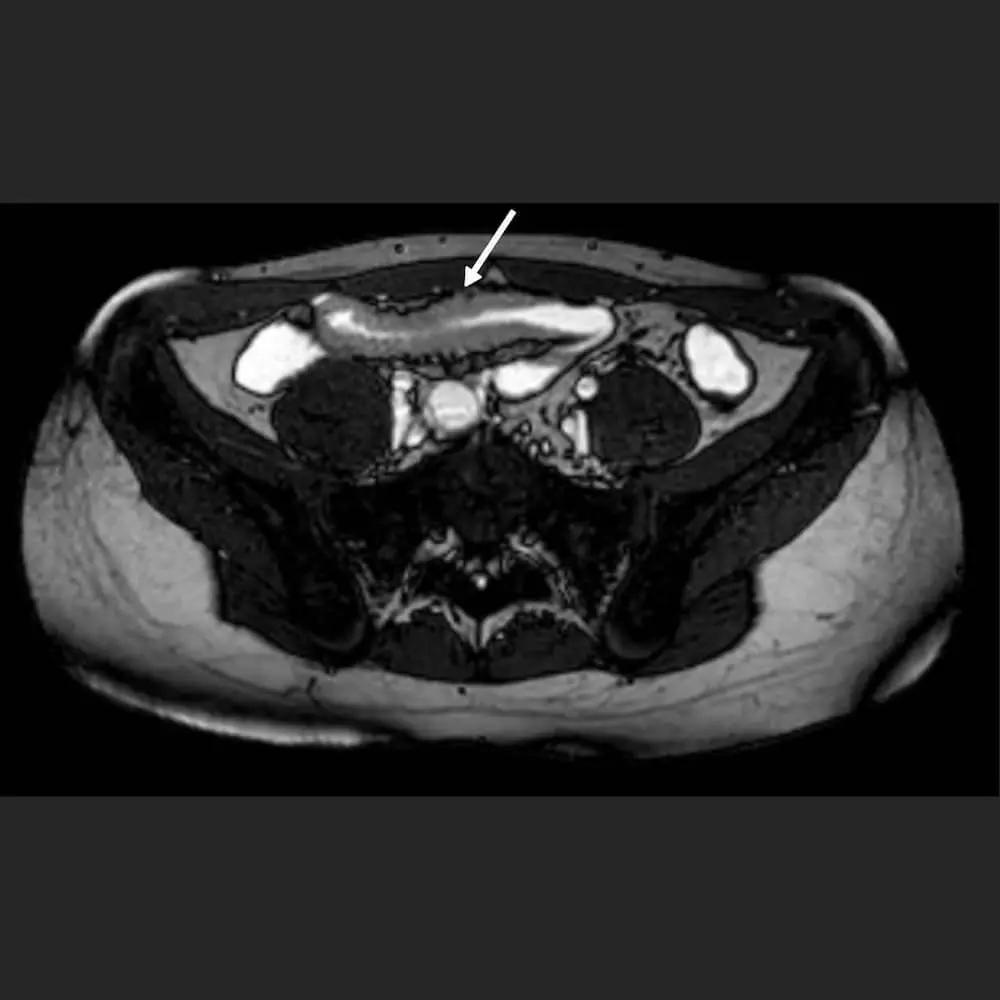 MRI Abdomen. Querschnitt des Dünndarms