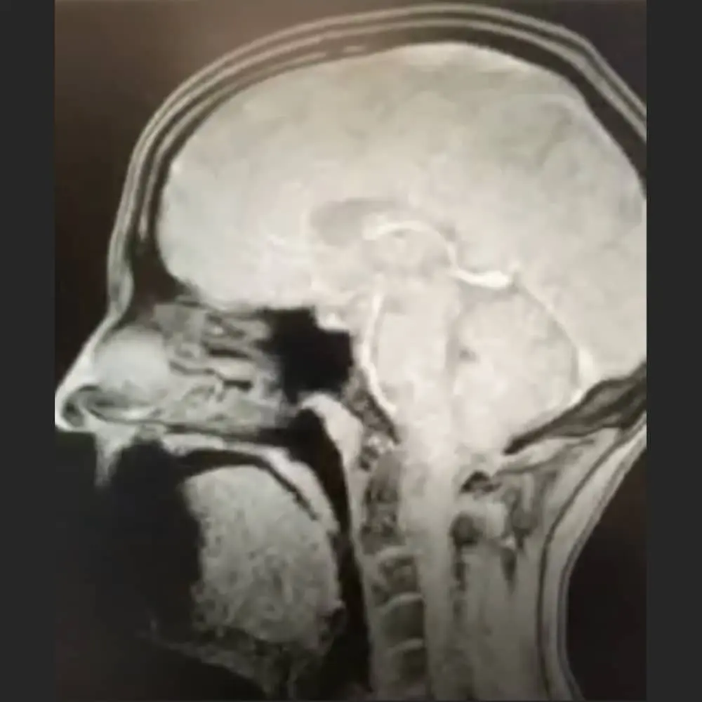 MRI-Bild des Halses bei einer Untersuchung wegen Schluckstörungen
