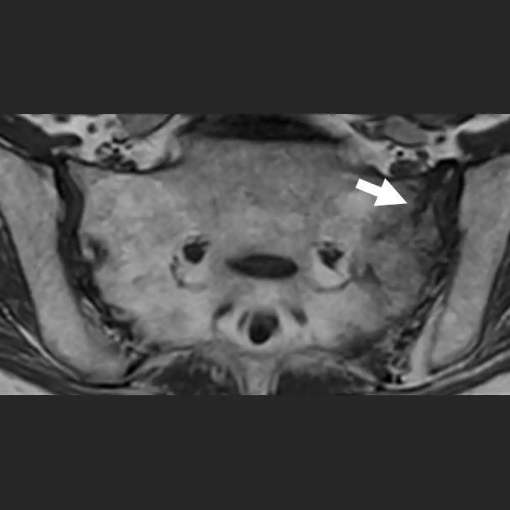 MRI-Aufnahme des Iliosakralgelenkes – Fraktur des Kreuzbeins bei Osteoporose