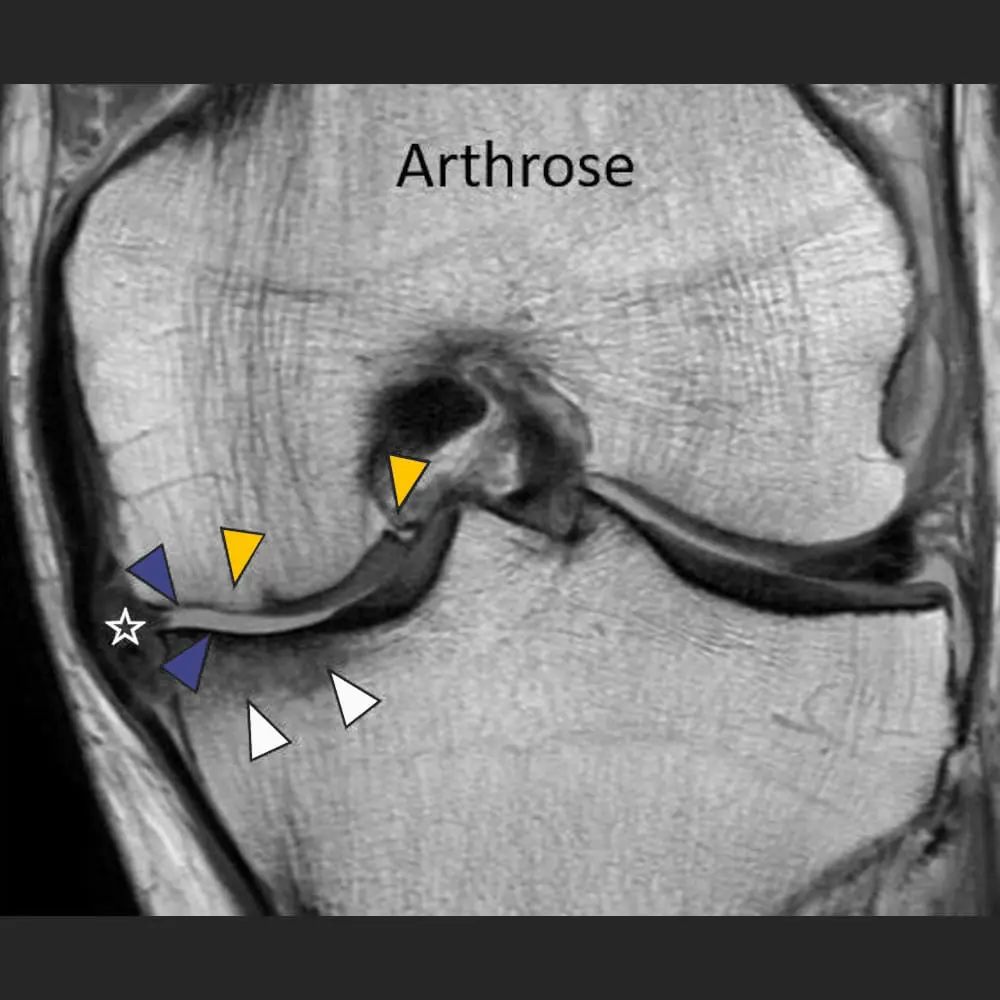 MRI Knie bei Arthrose