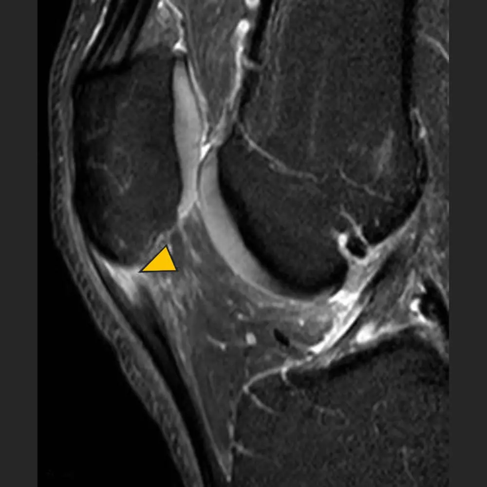 MRI Knie. Seitliche Ansicht des Kniegelenkes
