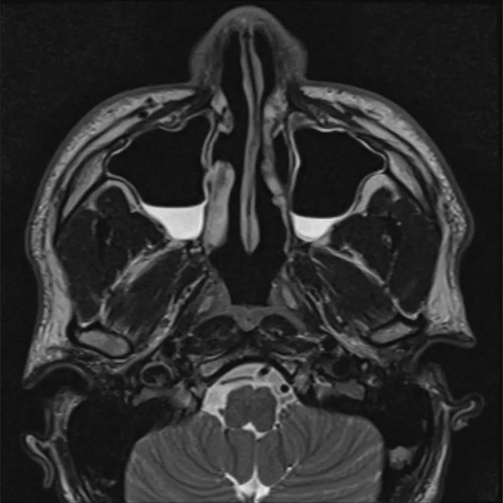 MRI der Nasennebenhöhlen