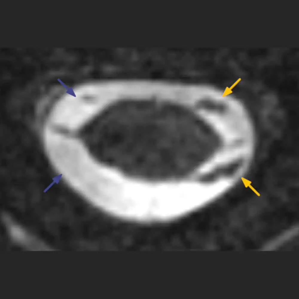 MRI-Aufnahme des Rückenmarks und der Nervenabgänge