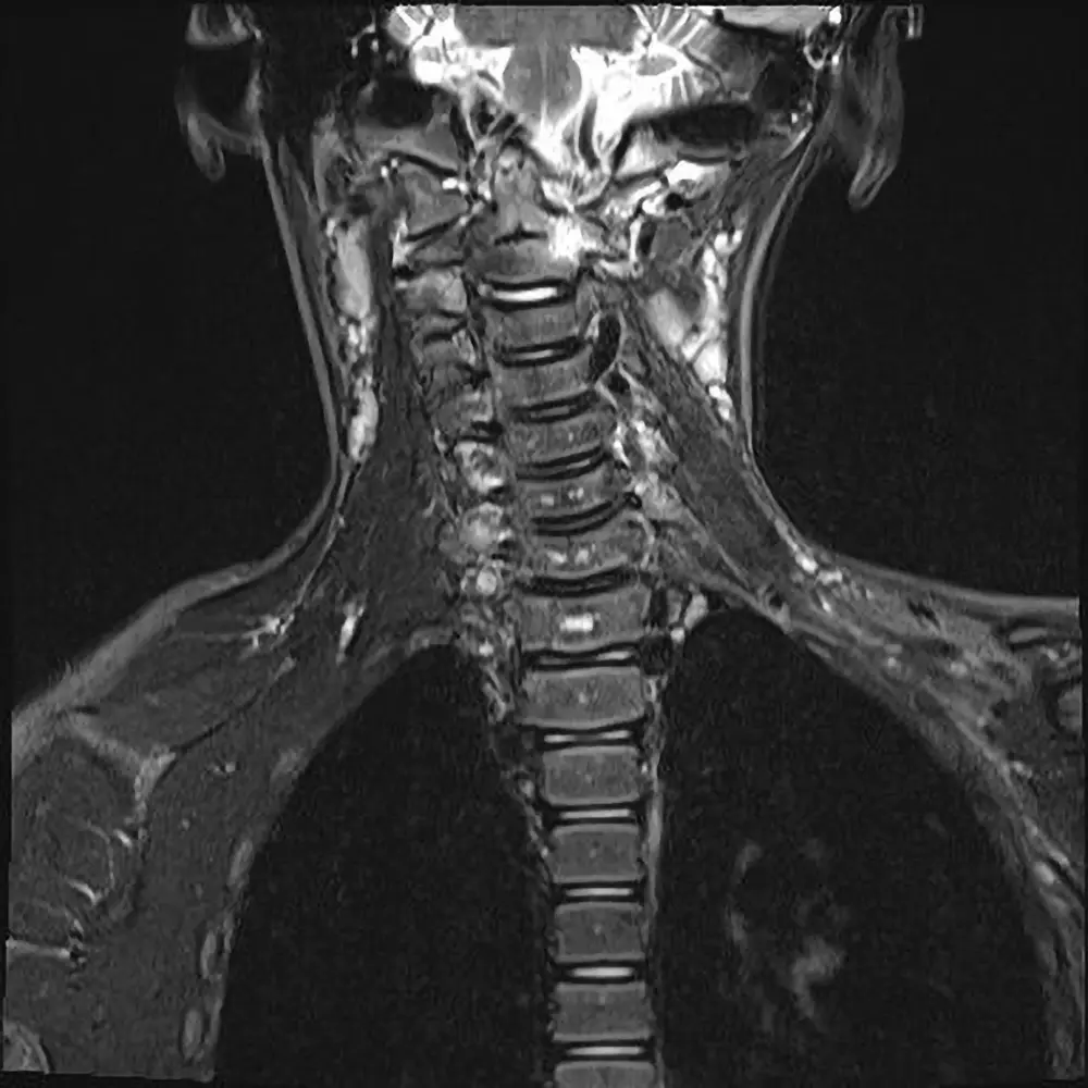 Kinder MRI Halswirbelsäule. Kindliche Arthritis der oberen Halswirbelsäule mit Fehlstellung.