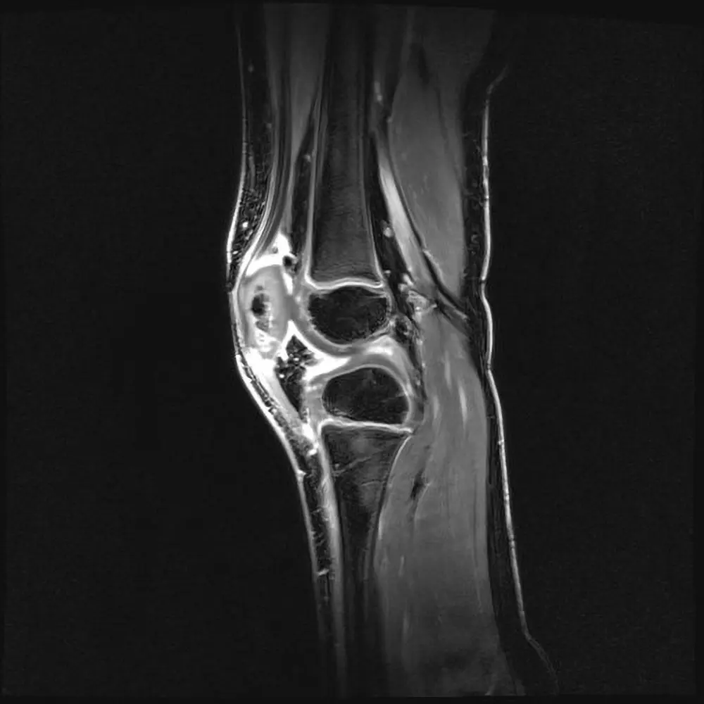 Kinder MRI Knie nach Kontrastmittel. Kindliche Arthritis.