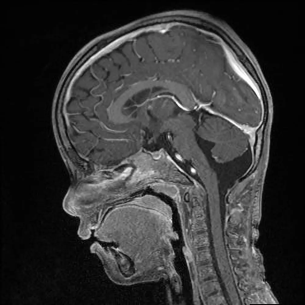 Kinder MRI Kopf nach Kontrastmittel. Normalbefund.