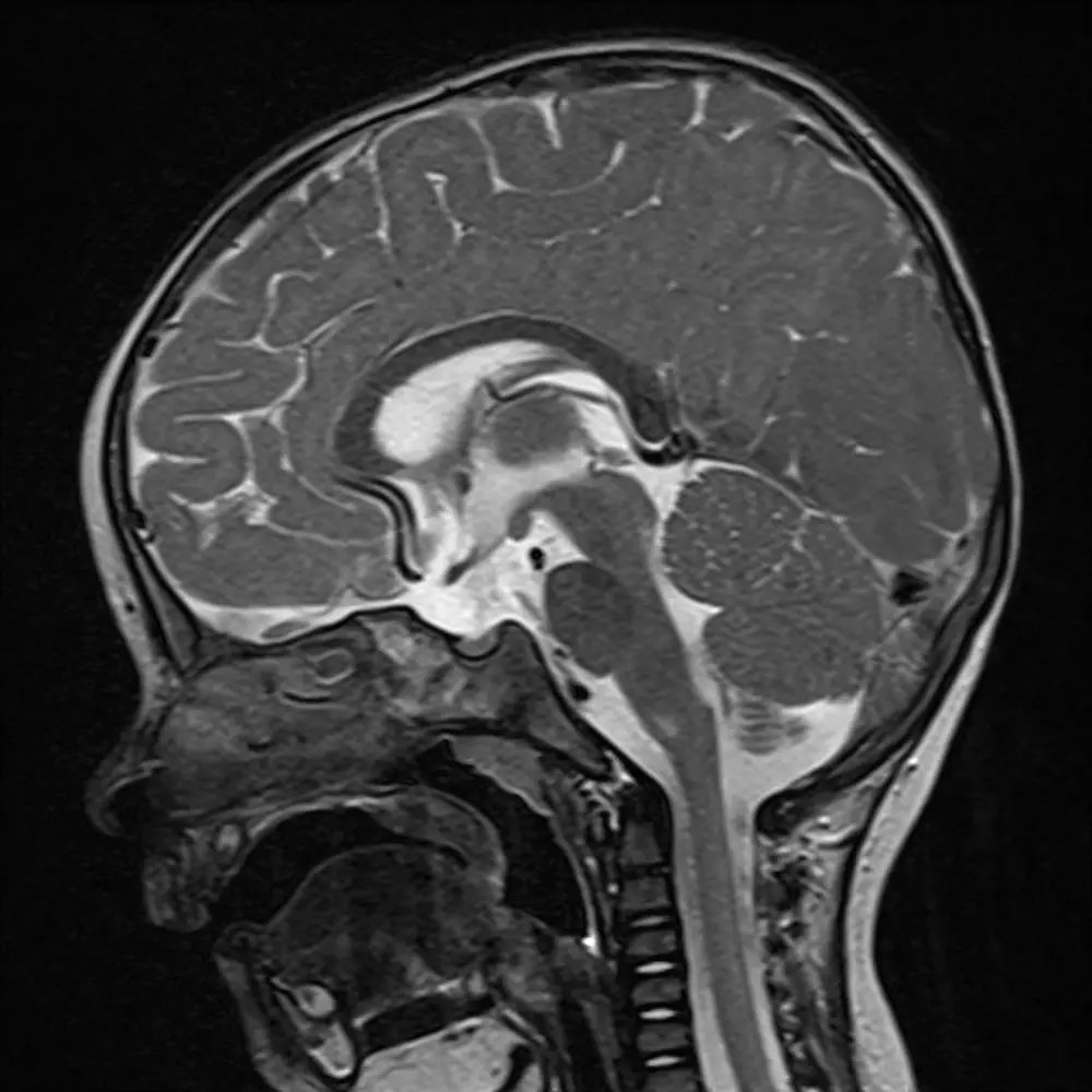 Kinder MRI Kopf seitlich. Normalbefund.