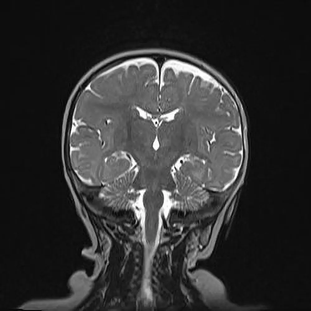 Kinder MRI Kopf. Normalbefund.