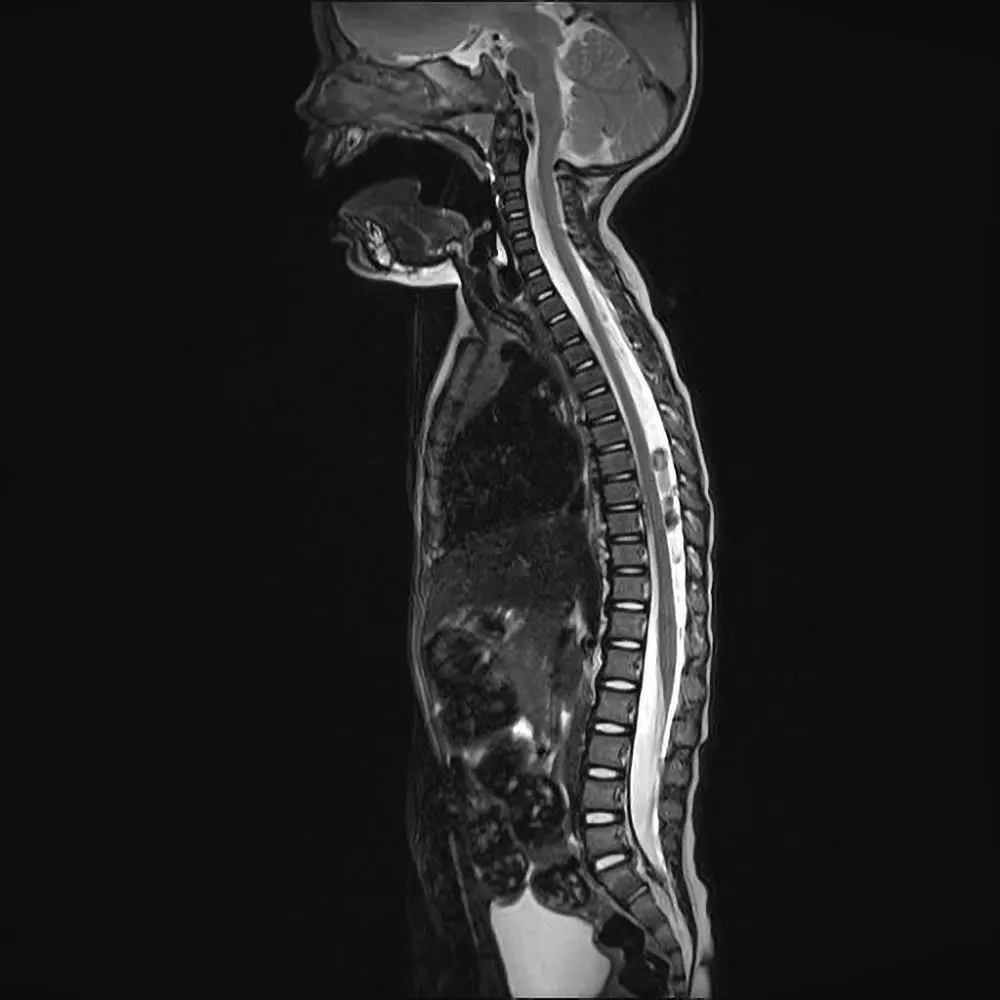Kinder MRI Wirbelsäule Seitenansicht. Normalbefund.