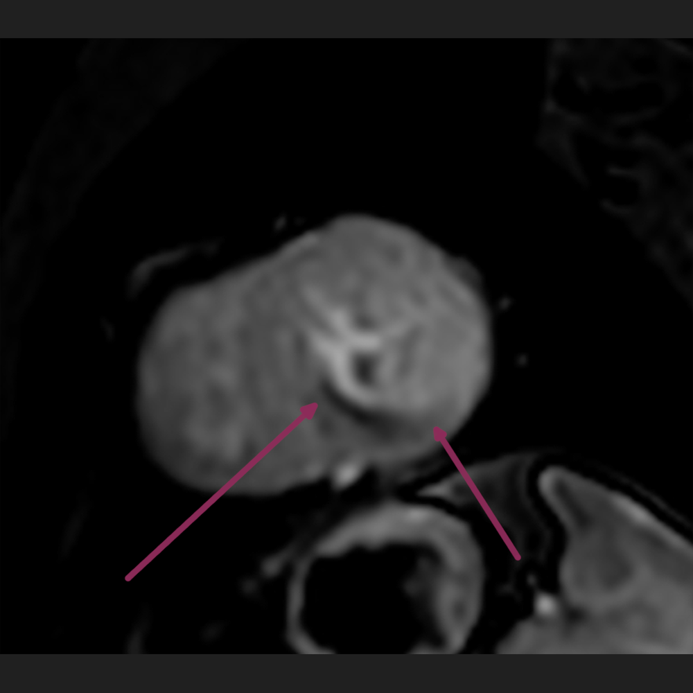 Stress-MRI des Herzens mit belastungsinduzierter Minderdurchblutung des Herzmuskels