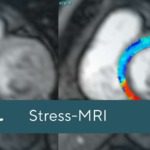 Stress-MRI