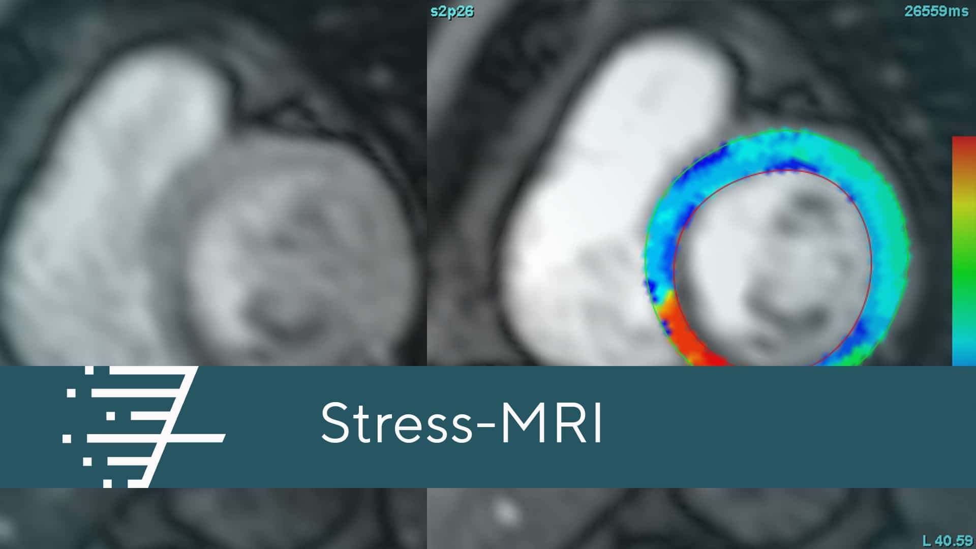 Stress-MRI bei ARISTRA