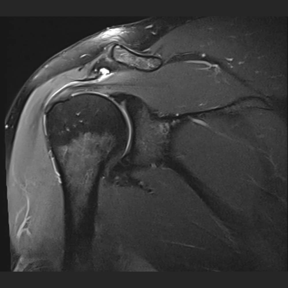 MRI-Bild einer Schulter mit leichter Schleimbeutelentzündung