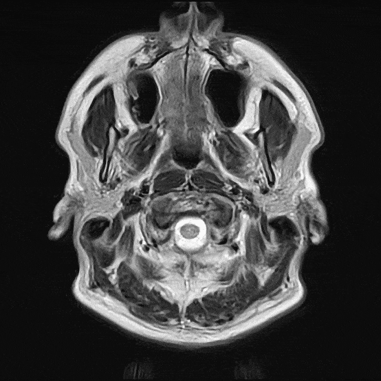 MRI des Gehirns – Aufgenommen während eines ARISTRA Ganzkörperscans