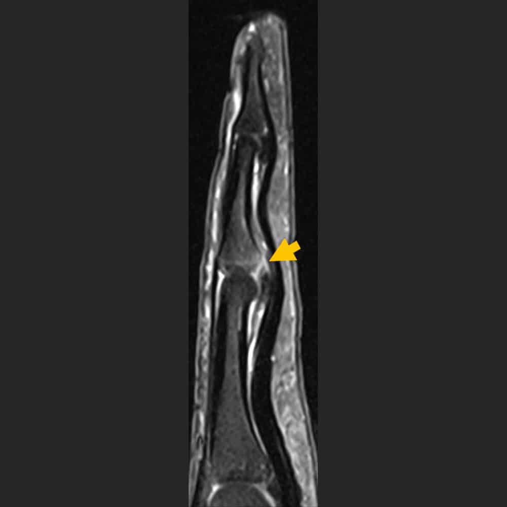 MRI-Bild eines Fingers bei ARISTRA
