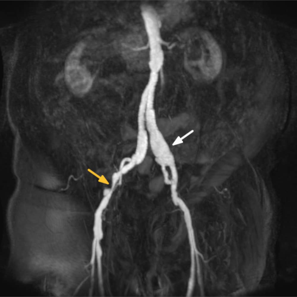 MR-Angiographie mit Engstelle im MRI