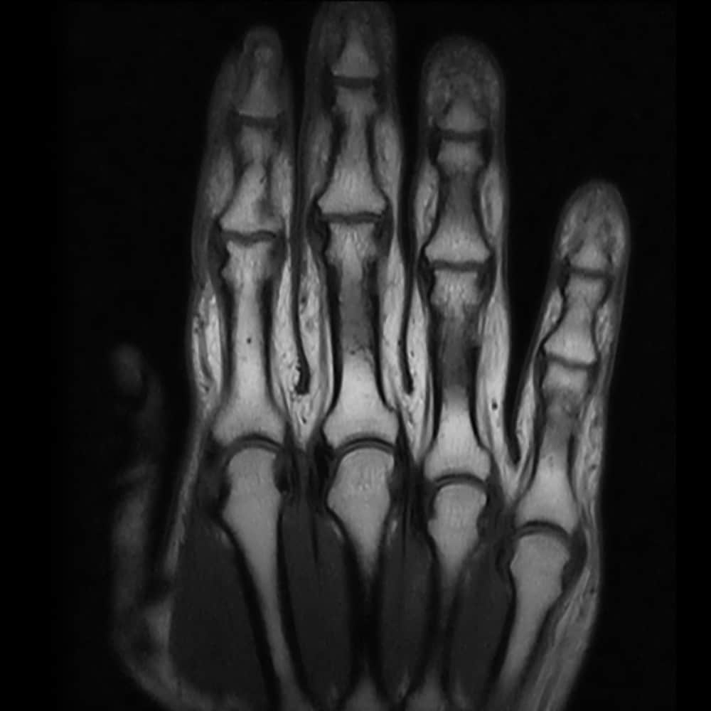MRI-Bild der Hand bei ARISTRA