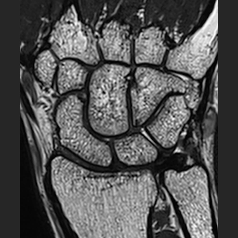 MRI-Bild vom Handgelenk bei ARISTRA