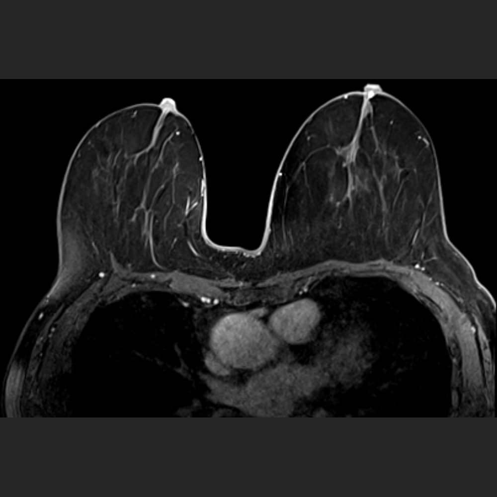 MRI Brust bei ARISTRA