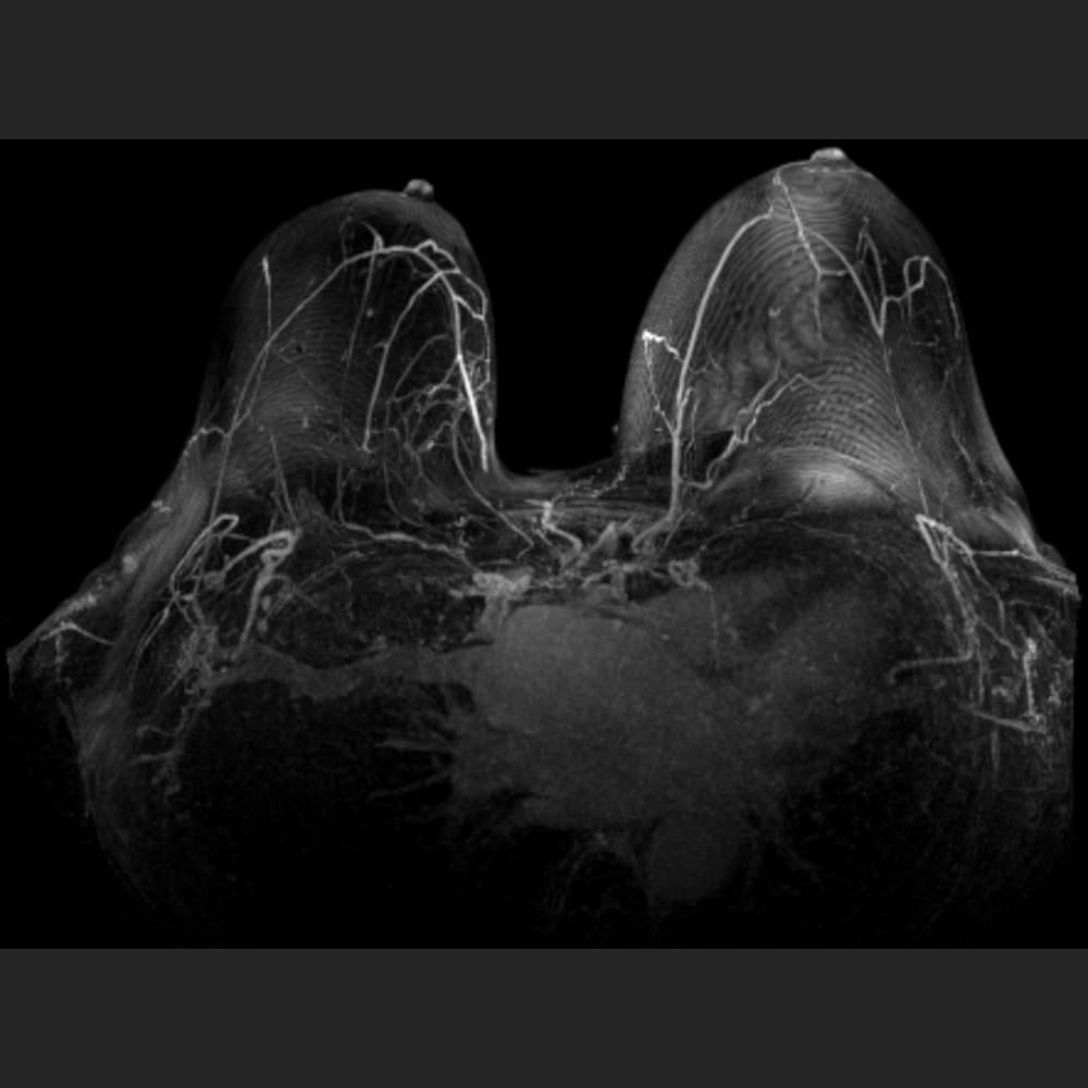 MRI-Bild der Brust