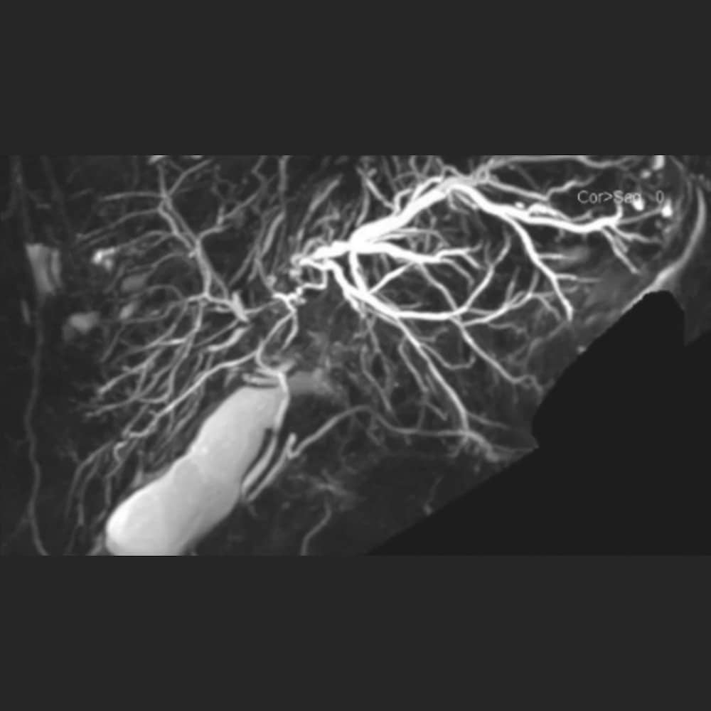 MRI-Aufnahme MRCP der Gallenwege