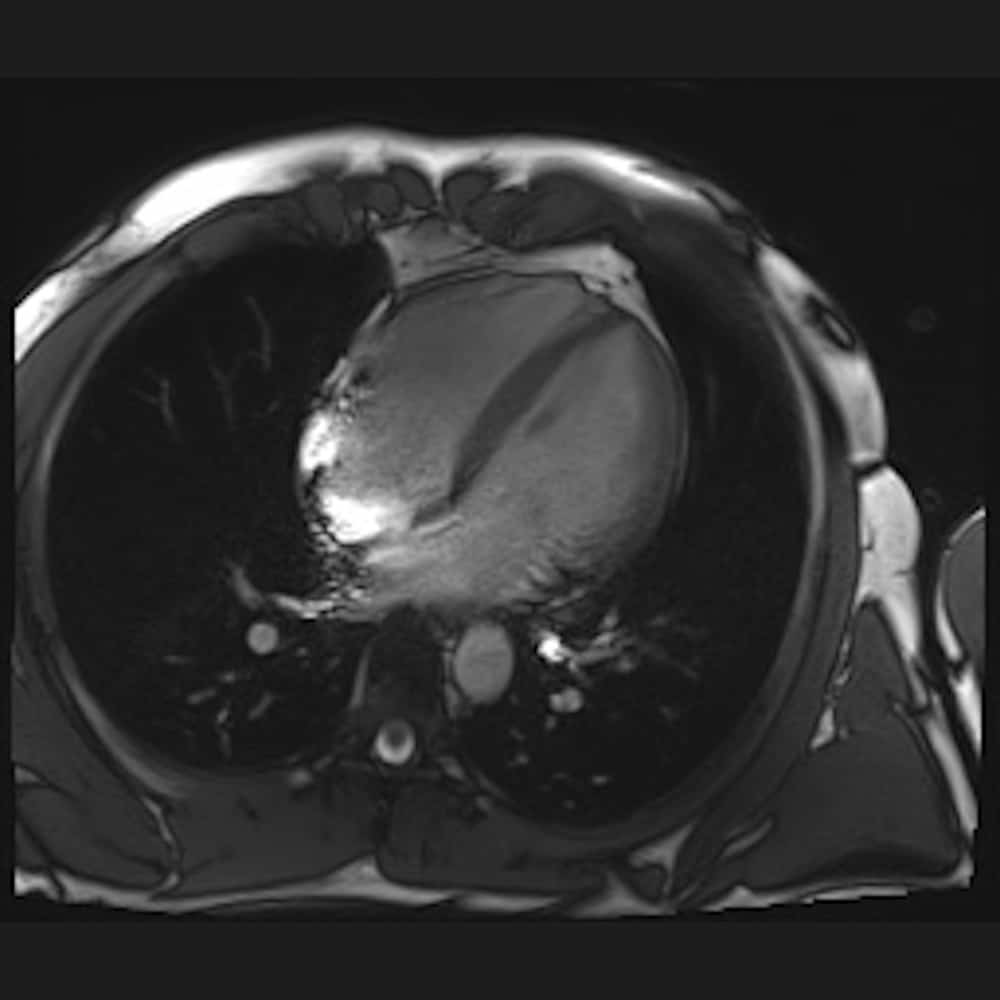 MRI Herz Aufnahme