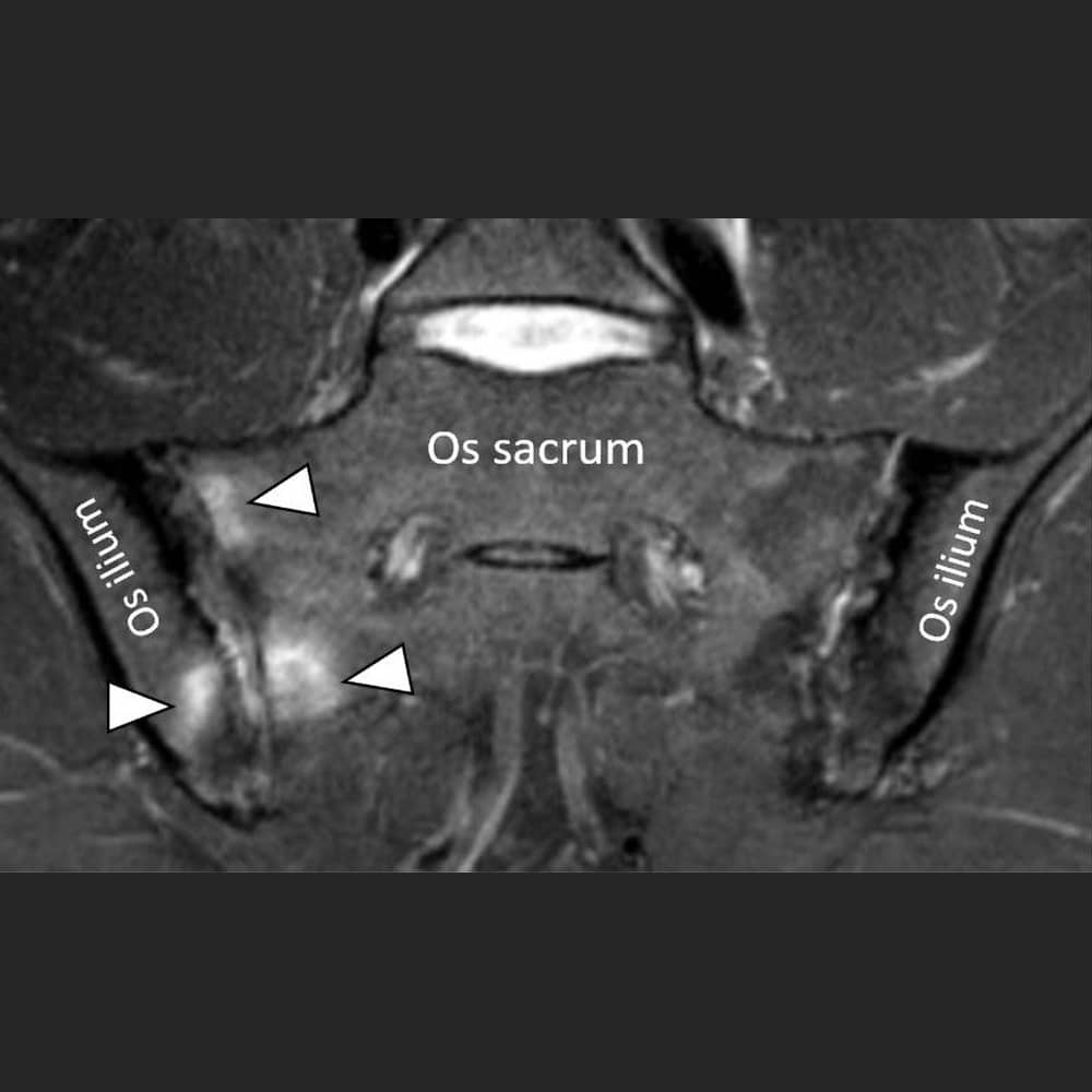 MRI-Aufnahme einer Entzündung (Arthritis) des Iliosakralgelenkes bei M. Bechterew