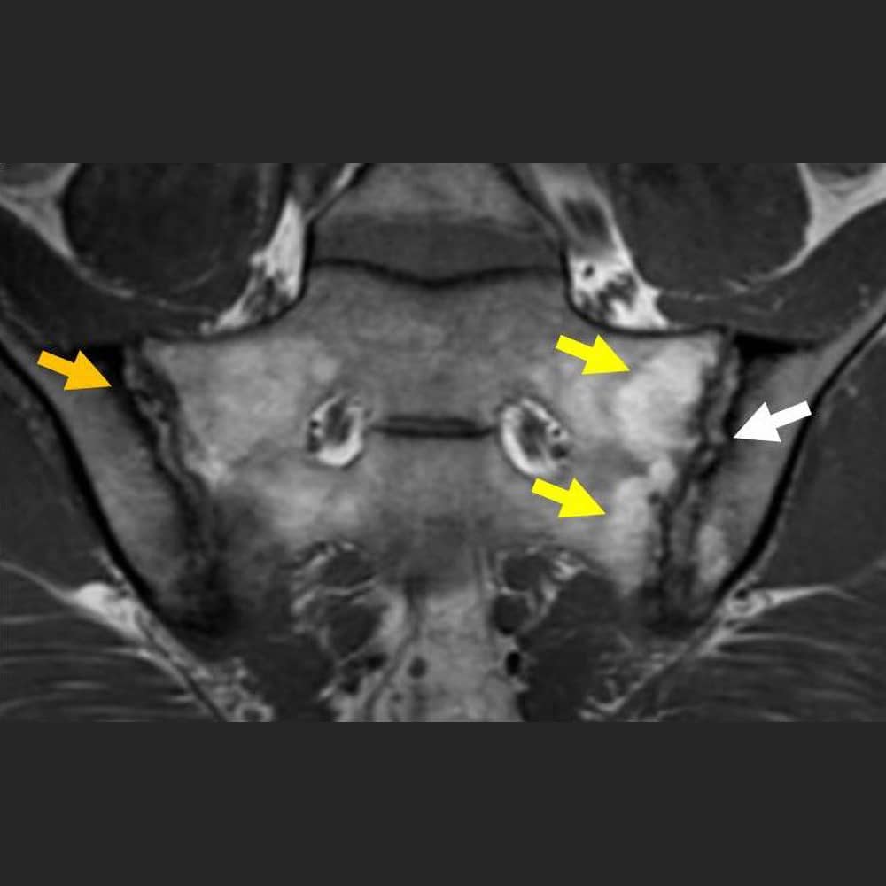 MRI-Aufnahme einer Entzündung (Arthritis) des Iliosakralgelenkes bei M. Bechterew T1 Sequenz