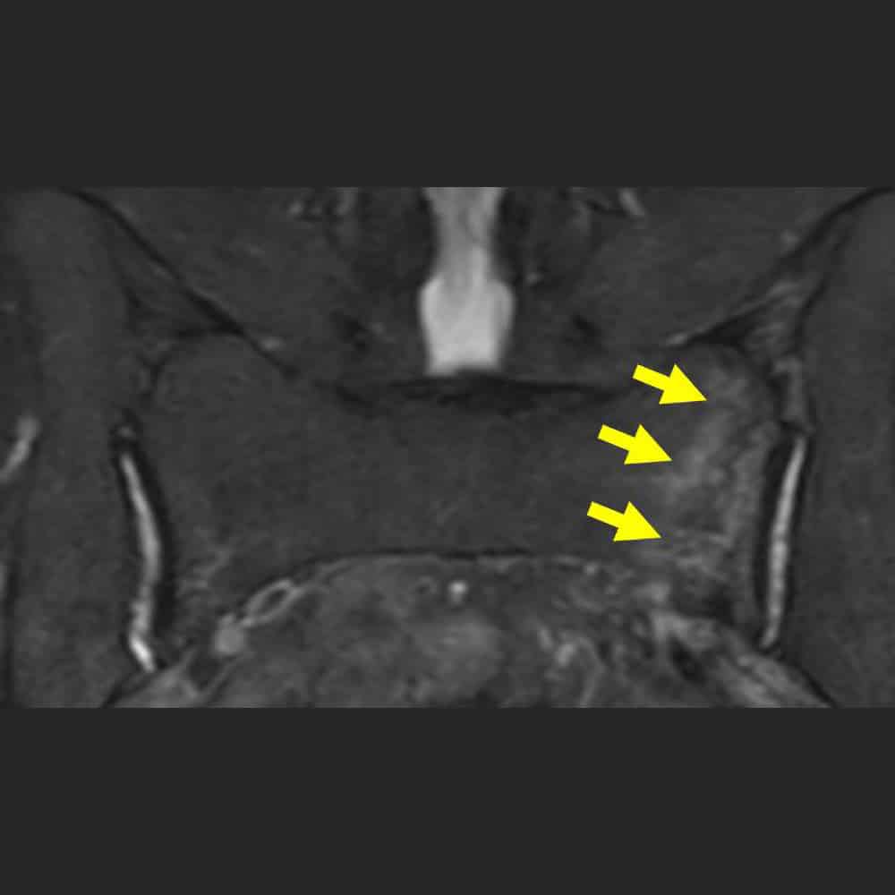 MRI-Aufnahme einer Fraktur des Kreuzbeins bei Osteoporose
