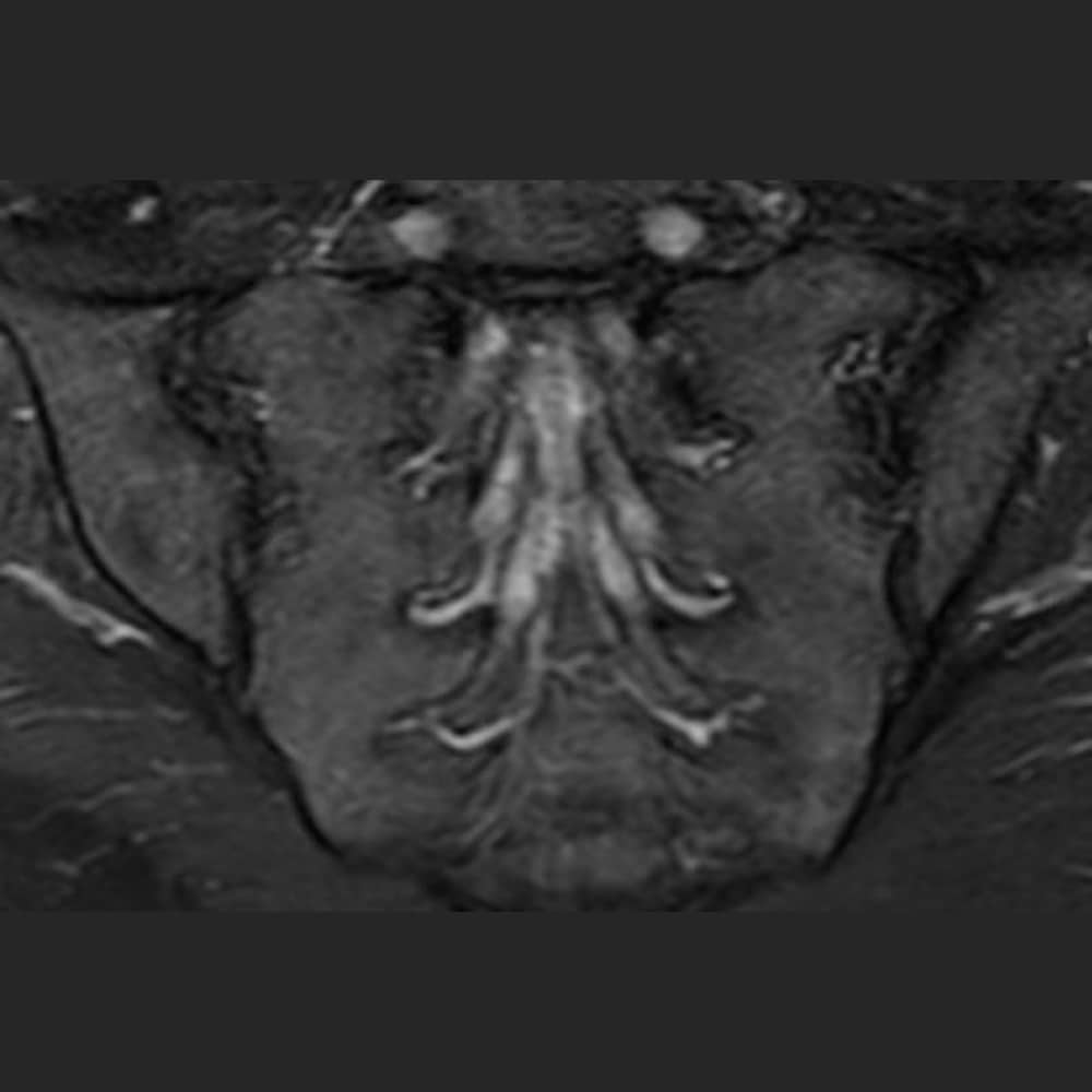 MRI Iliosakralgelenk STIR Sequenz bei ARISTRA