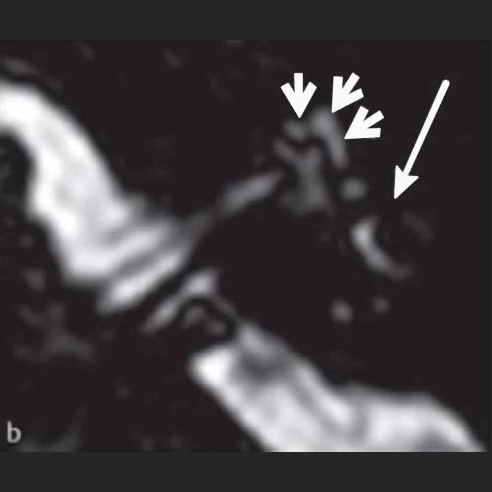 MRI-Aufnahme des Ohres bei Schwindel