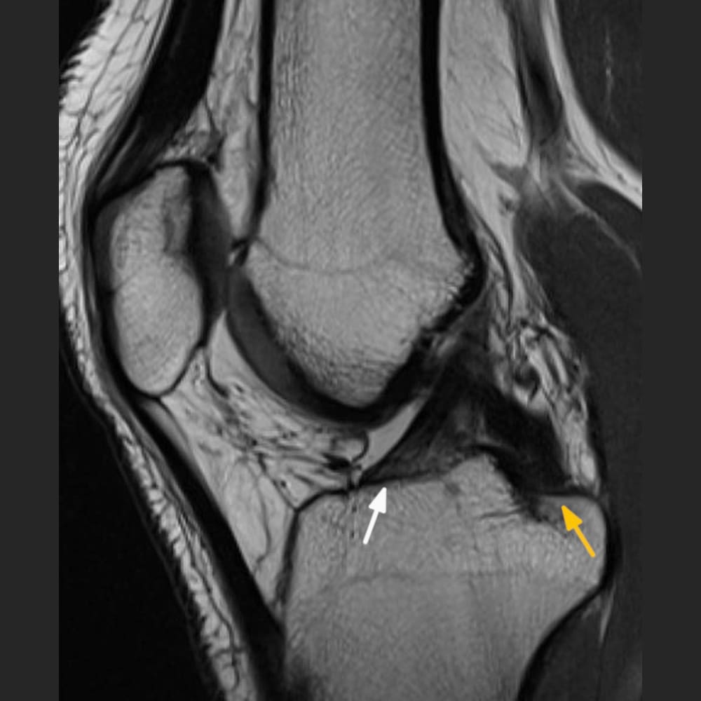 MRI-Aufnahme eines gesunden Knies