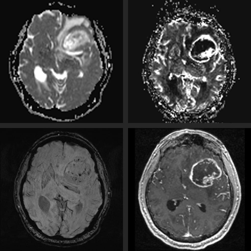 MRI-Aufnahme Hirntumor. Verschiedene Querschnitte des Gehirns