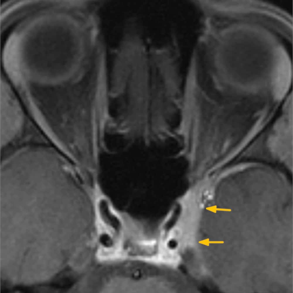 MRI Kopf und Hals. Querschnitt des zentralen Nervensystems