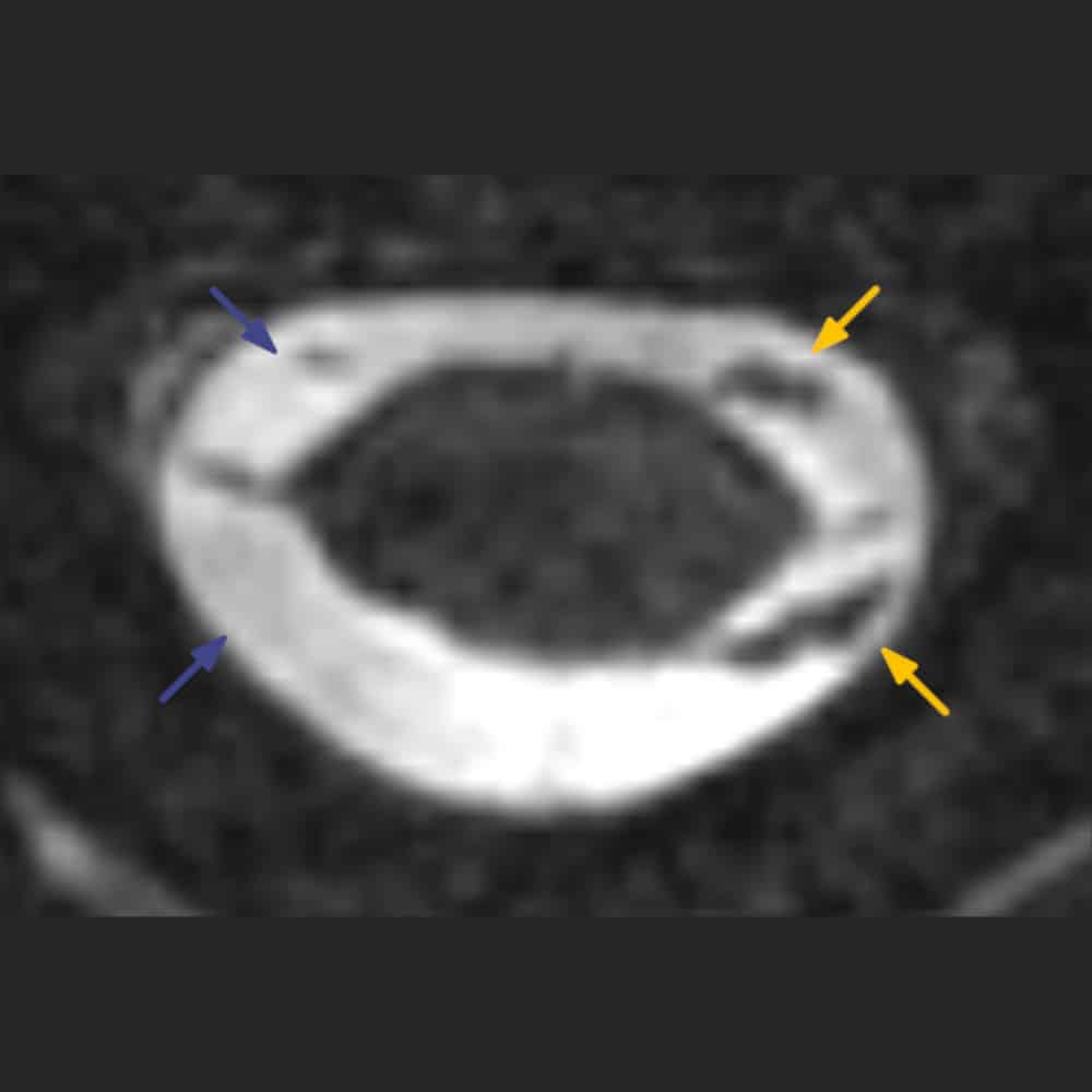 MRI-Aufnahme des Rückenmarks und der Nervenabgänge