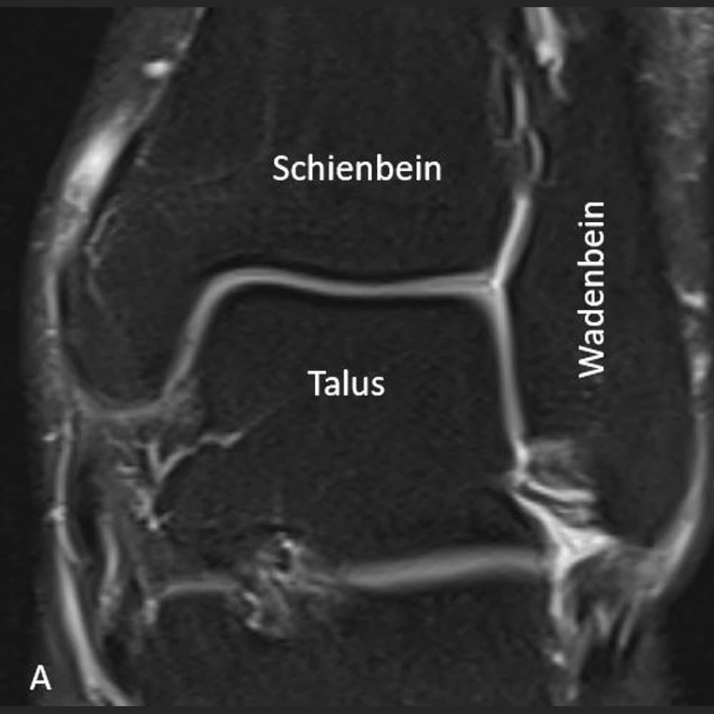MRI Frontalansicht des oberen Sprunggelenkes