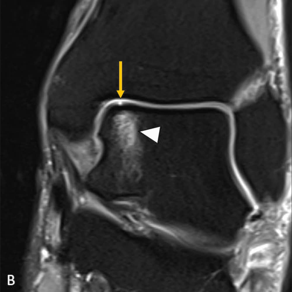 MRI-Aufnahme Sprunggelenk, Frontalansicht des oberen Sprunggelenkes