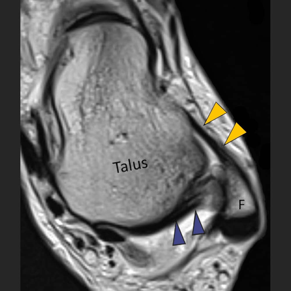 MRI Sprunggelenk, Querschnitt durch den gesunden Rückfuss