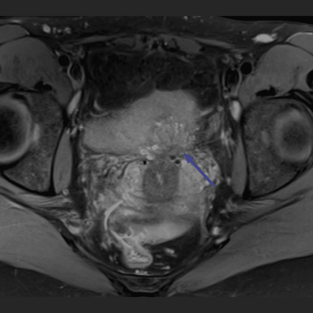 MRI-Aufnahme Unterleib bei Endometriose, Querschnitt