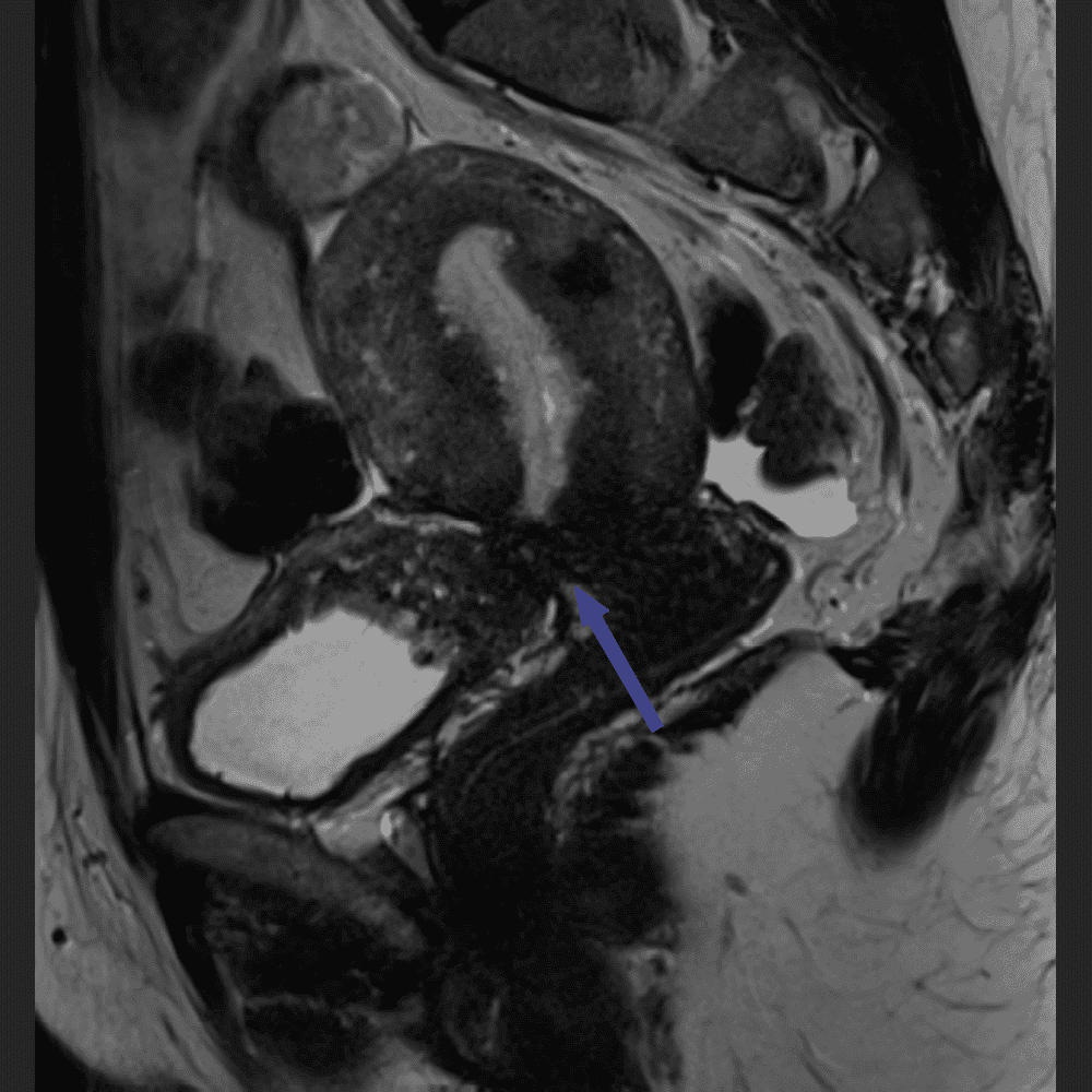 MRI Unterleib bei Endometriose, seitliche Ansicht