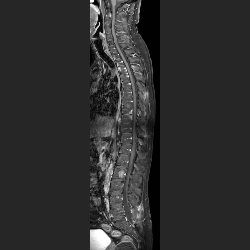 MRI der Wirbelsäule nach dem Bechterew-Protokoll
