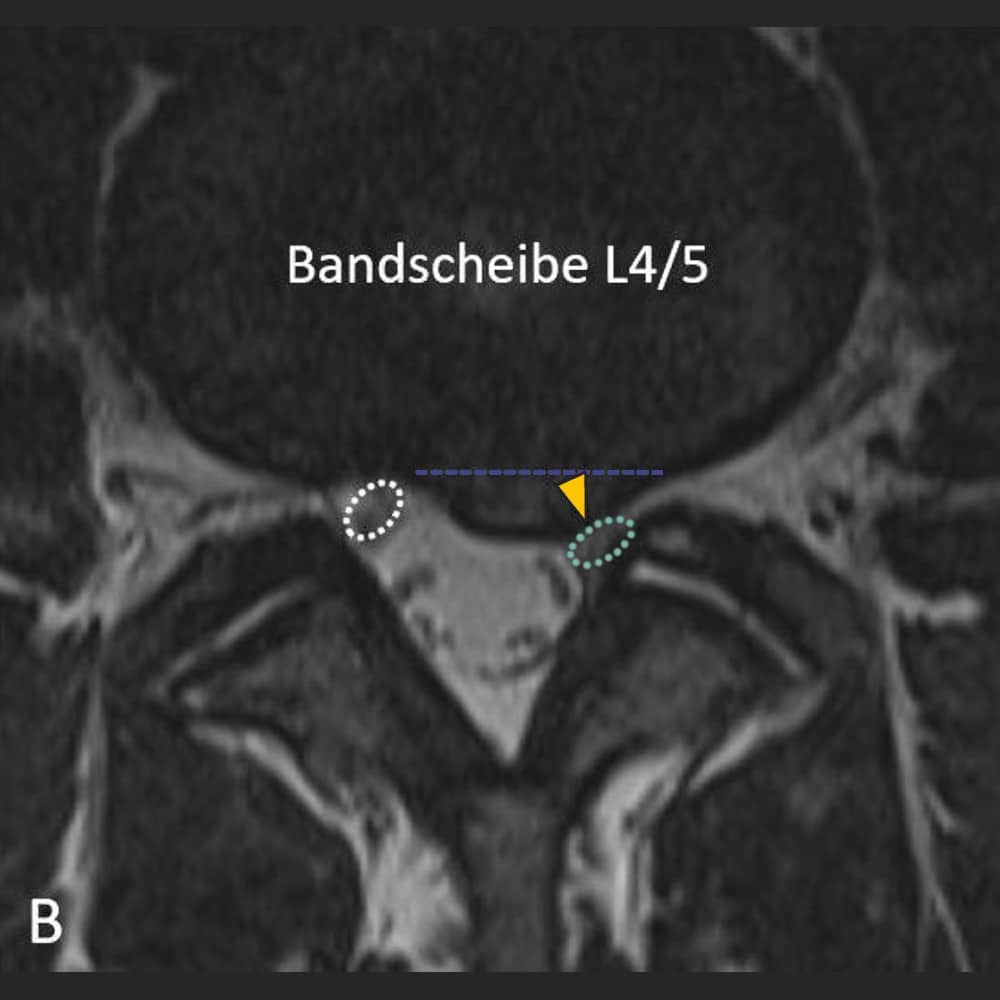 MRI Wirbelsäule – Transversale Ansicht auf Höhe der Bandscheibe L4/5