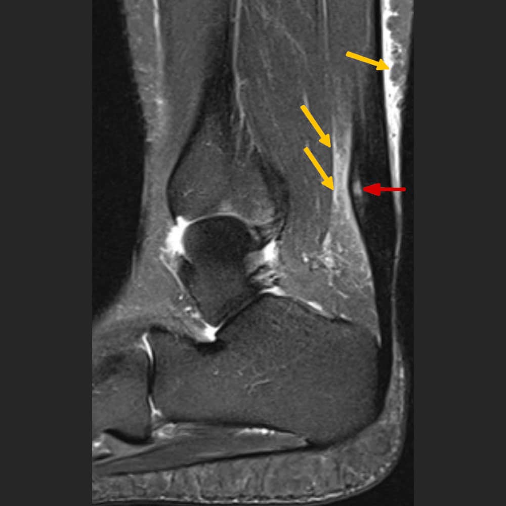 MRT einer Achillestendinopathie im Mittelteil der Sehne mit kleiner Ruptur in der Sehne (roter Pfeil) und umgebendem Reizzustand (gelbe Pfeile)