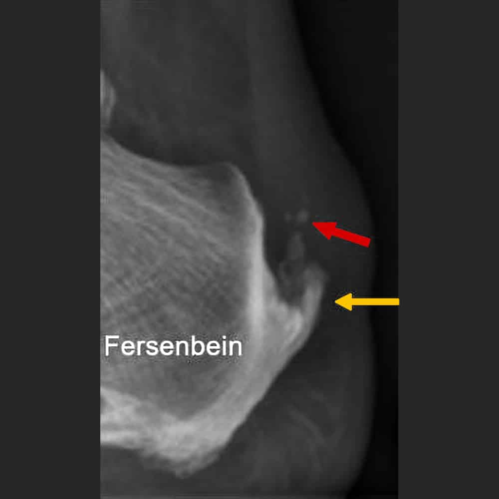 Verkalkungen (roter Pfeil) und Achillessporn (gelber Pfeil) bei Tendinopathie der Achillessehne am Ansatz