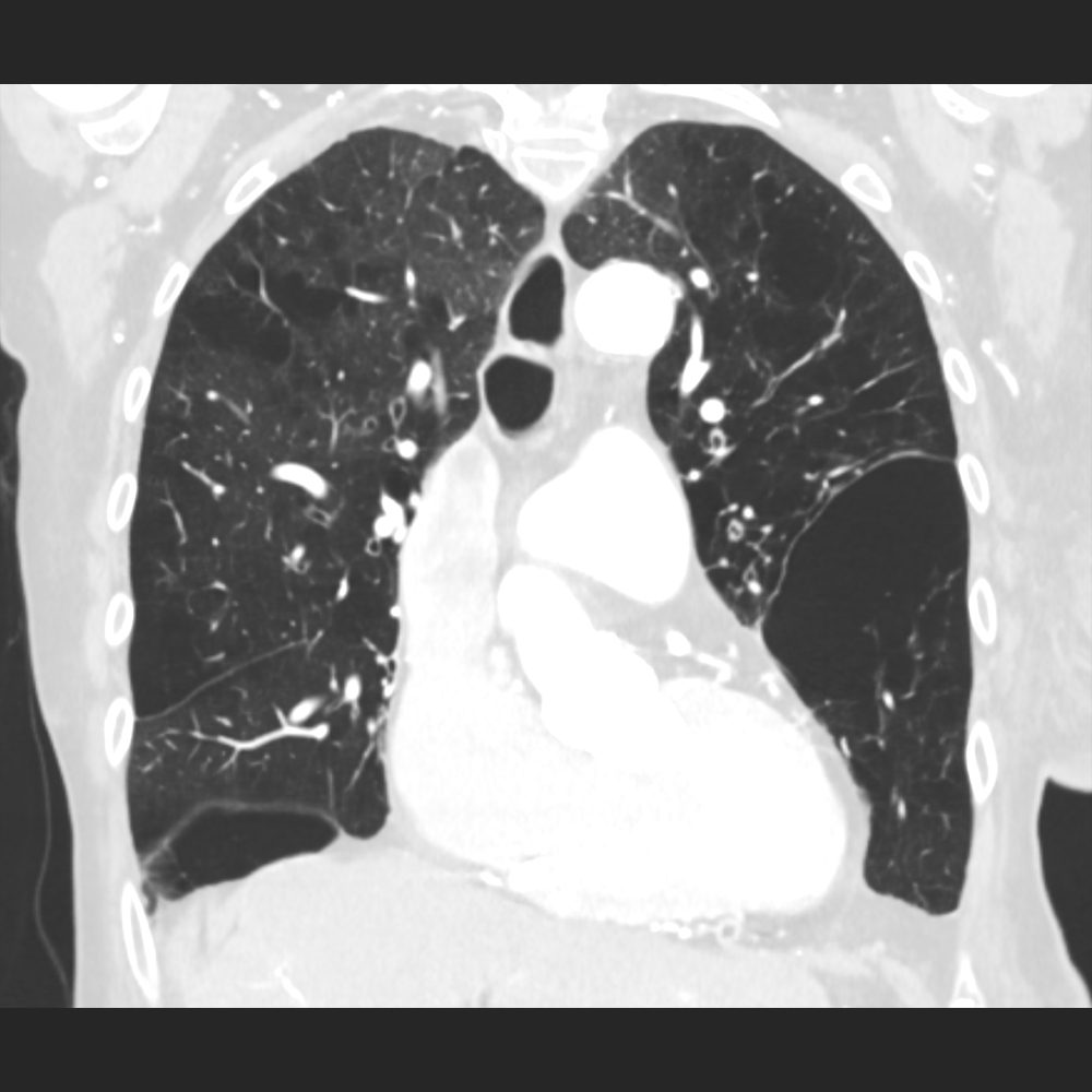 Lungen CT mit COPD