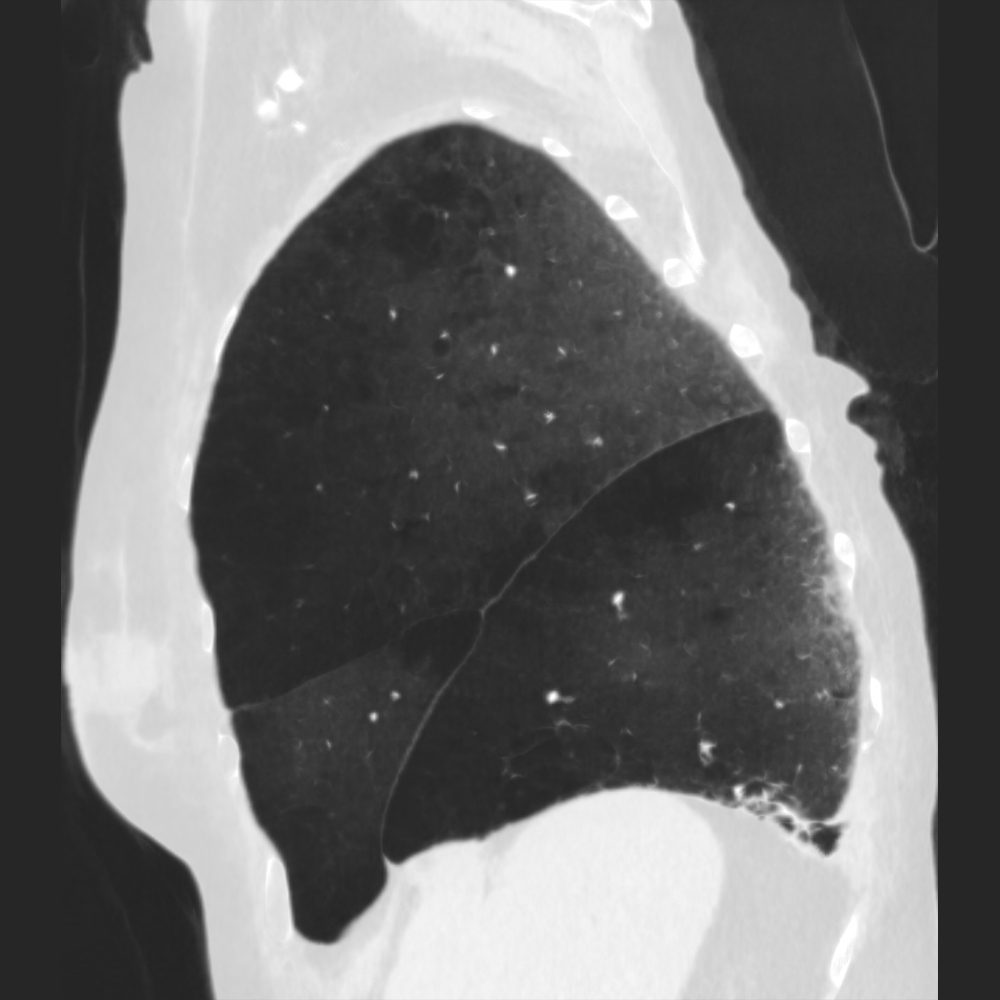 Lungen CT sagittal mit COPD